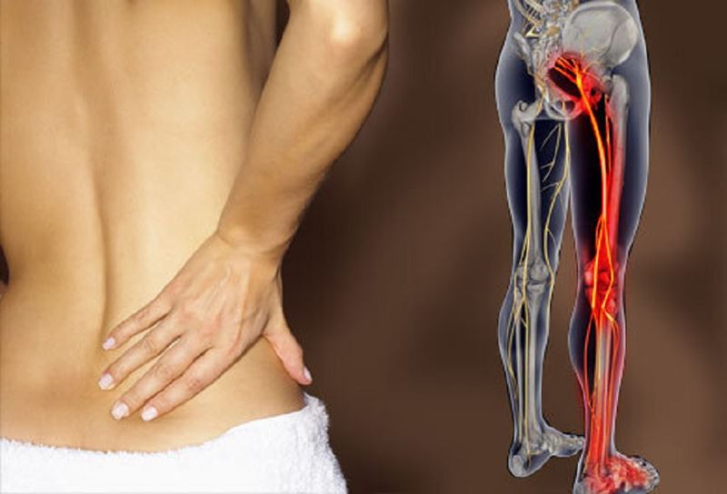 medyfit fisioterapia sciatica sciatalgia lombalgia lombosciatalgia verona